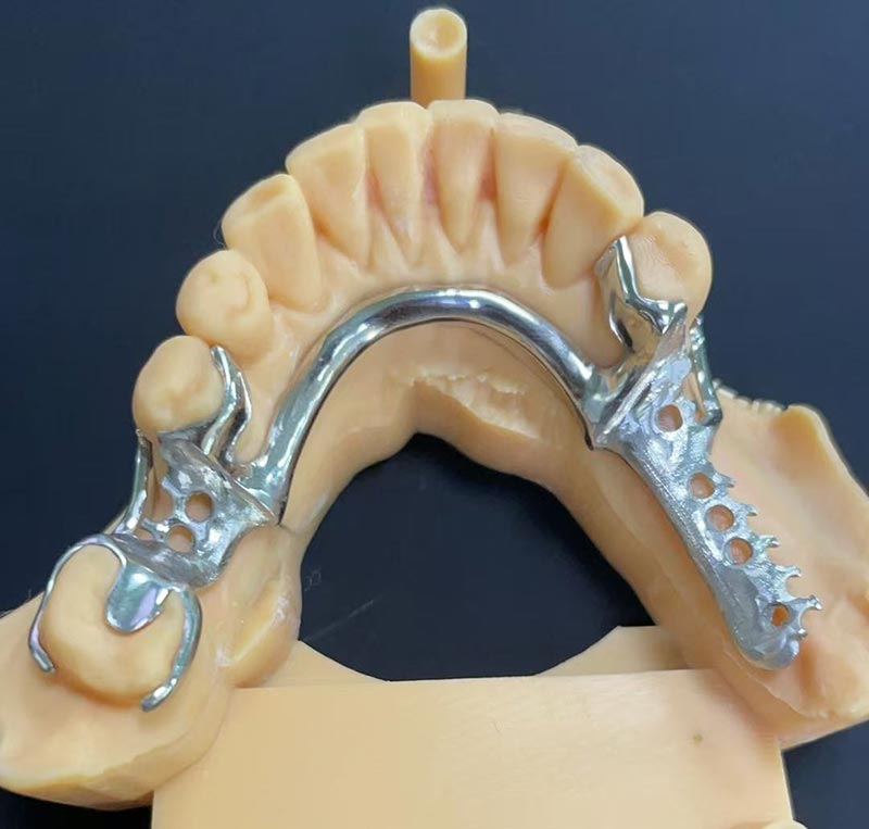 Cobalt-Chromium Framework(Co Cr Framework)의 장점