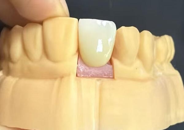 치아 사이의 틈도 고칠 수 있습니다. 곧은 치아가 가장 매력적입니다!