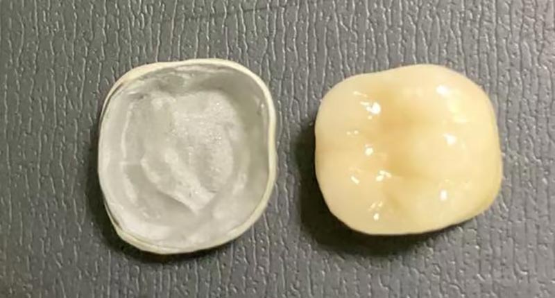 도자기 왕관에 칩이 생겼을 때 어떻게 해야 할까요? 문제가 발생하는 이유와 해결 방법은 다음과 같습니다.