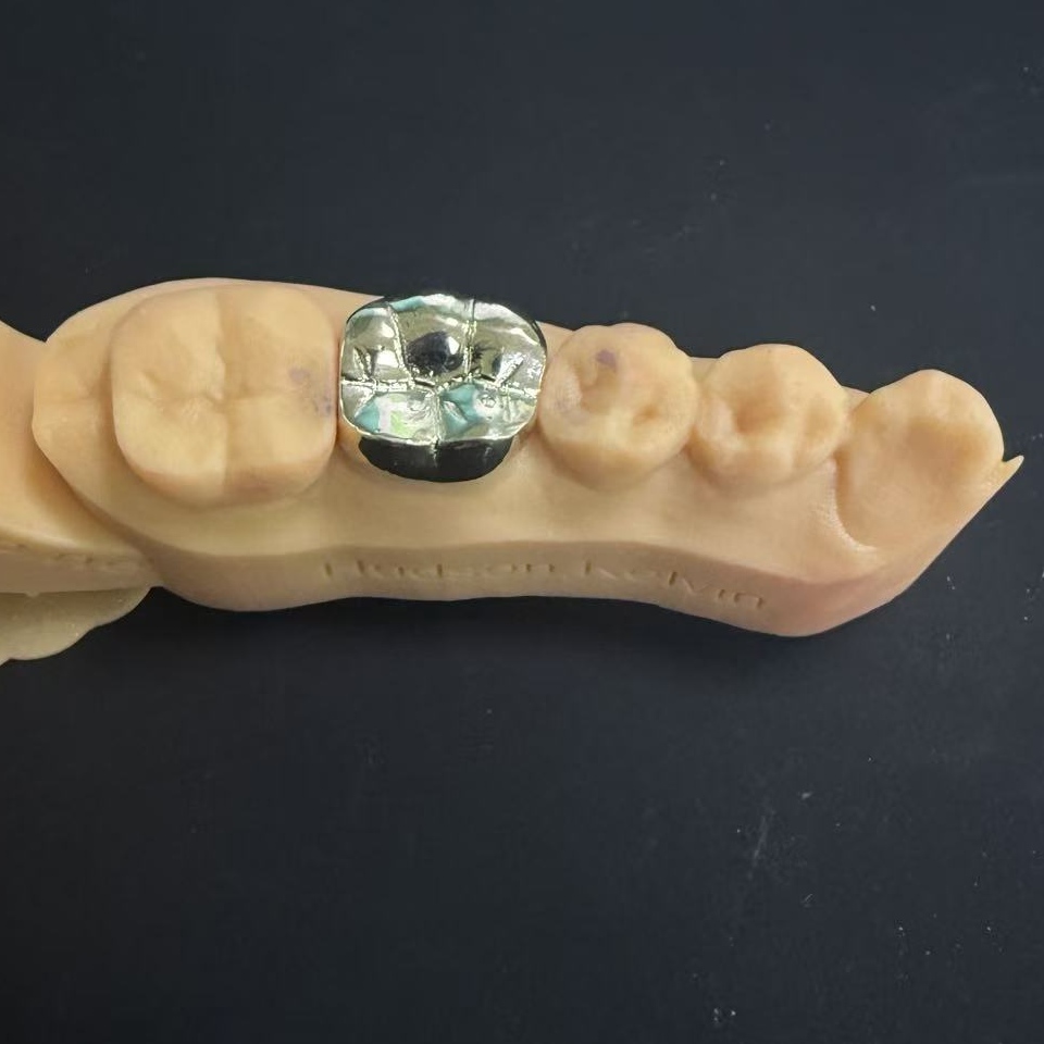 골드 크라운: 평생 치아 복원을 위한 귀금속 선택