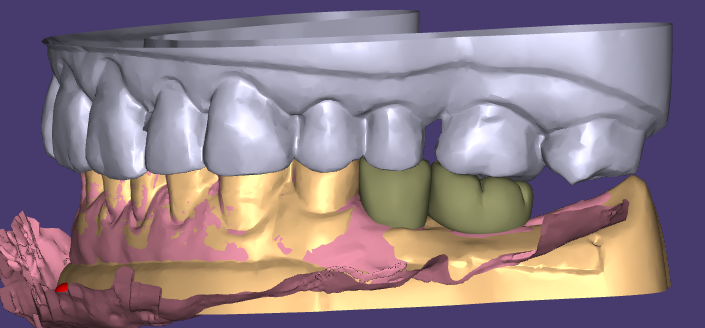 WM Dental Lab의 미적 왁스업 및 임시 수복물이 만장일치로 고객의 호평을 받음