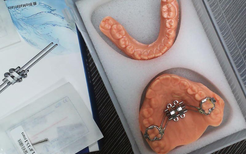 WM Dental Lab을 통해 MSE 골격 확장 이해