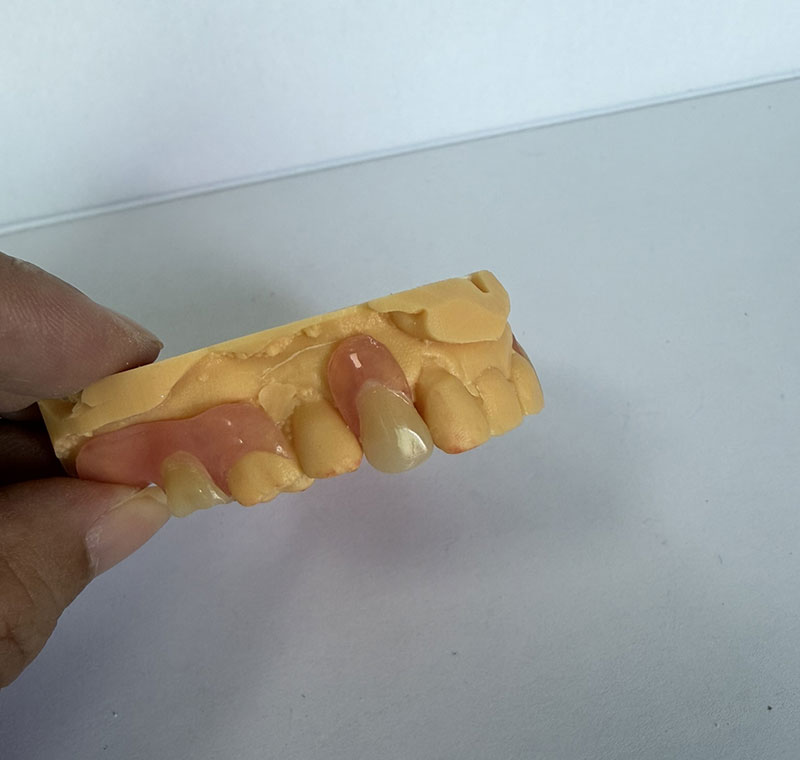 WM Dental Lab의 Valplast Partials