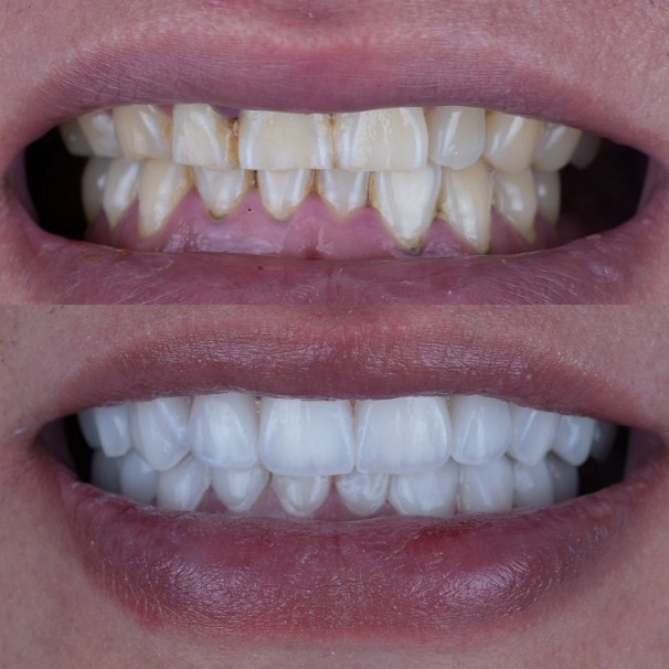 Emax Layered Veneers Esthetic China 치과 연구소 작업