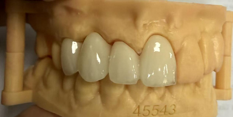 crown material
